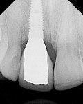Figure 18  Definitive all-ceramic NobelProcera crown cemented in place (radiograph confirming no residual cement around implant).