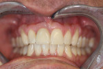 Figure 19  Intraoral photograph of results at 1 year.