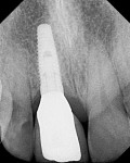 Figure 20  Radiograph of results at 1 year (note the bone height at the collar of the implant, which supports healthy soft tissue architecture).