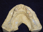Figure 1 Kennedy Class I bilateral distal extension.
