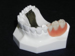 Figure 7 A precision-attachment partial denture.