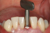Fig 1. Ground section of a primary incisor with arrested caries lesion after SDF treatment. Fig 1: Arrested caries that had SDF treatment. Fig 2: Microhardness of dentin (in median Knoop hardness number) in soft and SDF-arrested caries according to the distance from the lesion surface. (images from Chu and Lo, 200820 [reprinted with approval])