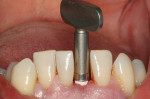 Figure 5A  Fixture seated with Manual Snap-In Key Driver. Note initial insertion was done with the Handpiece Driver. The gingival sleeve was now subgingival (this will prevent resin from locking under the fixture). A radiograph was taken to verify th