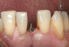 Fig 1 and Fig 2. Ground section of a primary incisor with arrested caries lesion after SDF treatment. Fig 1: Arrested caries that had SDF treatment. Fig 2: Microhardness of dentin (in median Knoop hardness number) in soft and SDF-arrested caries according to the distance from the lesion surface. (images from Chu and Lo, 200820 [reprinted with approval])