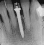 Figure 5C  Fixture seated with Manual Snap-In Key Driver. Note initial insertion was done with the Handpiece Driver. The gingival sleeve was now subgingival (this will prevent resin from locking under the fixture). A radiograph was taken to verify th