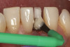 Fig 5. Use of 38% SDF to arrest coronal caries in primary teeth of a young child. The arrested carious lesion had a hard, blackened, and impermeable layer.