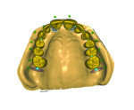Fig 1. The new software update allows movement of teeth as a group, maintaining the contact relationships with adjacent teeth.
