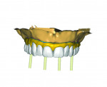 Fig 4. Esthetic and functional CAD design.