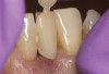 Fig 6. Use of 38% SDF to arrest root caries in permanent teeth of an elderly patient. Fig 6: The arrested root carious lesions were hard to probe.