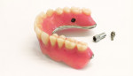 Fig 12. The MK1 attachments are inserted into the final polished denture.