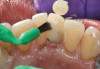 Fig 7. The lower incisors were responsive to electric pulp testing with no radiographic pathology.