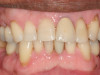 Fig 9. Use of 38% SDF to arrest rampant caries in a young teenager. Fig 8: Pre-treatment intraoral frontal view of rampant caries. Fig 9: Frontal view of arrested caries after consecutive application of SDF for 3 weeks. (images from Chu, et al, 201436 [reprinted with approval])