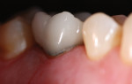 Discolored ceramic e.max crown with gingival decay.