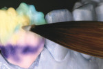 Figure 6  GC Initial™ porcelain cervical translucency dentin enamel was layered.