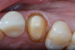 #00 Re-Cord placed on top of the thinner one soaked in hemostatic solution (Hemodent).
