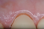 Note the soft-tissue retraction still present at the moment of temporary cementation. A resin-optimized, non-eugenol temporary cement (Cling 2, Clinicians Choice) was selected due to its mechanical and biological properties.