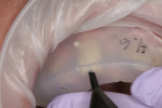 Injection of resin into the secured restorative
matrix. Note the extruded material from the vent hole at the distofacial of tooth No. 6, signifying completion of the fill.