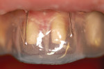 The restorative matrix seated and verified on teeth Nos. 8 and 9 prior to injecting restorative material. Note the translucent character.