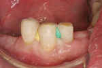 Cervical embrasure undercuts blocked out with assorted wooden wedges that have been trimmed flush.