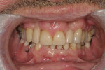 Case 1, posttreatment retracted occlusion with improvement in deep bite and the occlusal plane.