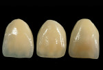 Figure 11  After applying clear, incisal enamel to the sample crowns, the final mamelon appearance was different than with just the flo dentin effect.