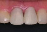 Figure 4B  <strong>Figure 4B</strong>Provisional crowns completed.