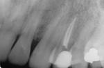 Debridement of the dentin is completed after the endodontic treatment is completed.