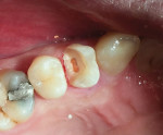 Debridement of the dentin is completed after the endodontic treatment is completed.