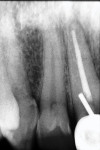 Radiograph showing completed root canal therapy for the maxillary right central incisor with a metallic post placed outside the confines of the root canal space.