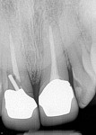 Radiograph showing horizontal fracture at the mesio-gingival aspect of the maxillary right central incisor just apical to the crown margin.
