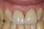 Porcelain-fused-to-metal crowns placed for maxillary central incisors in 1996.