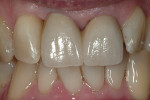 Short-term follow-up of the splinted crown restorations for the central incisors.