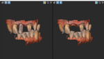 Intraoral impression scans taken of the maxillary central incisors at 14 weeks post-implant placement. Note an optical scan body is present in one view and absent in the other, as is required by the digital workflow.