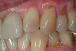 Left lateral view of the splinted crown restorations for the central incisors.