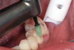 A medium (green) point was used to polish the cervical surface at a slow speed with water and light pressure.