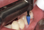 An ultrafine (blue) point was used to polish the cervical surface at a slow speed with water and light pressure.