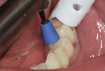 An ultrafine (blue) cup was used to polish the occlusal surface at a slow speed with water and light pressure.