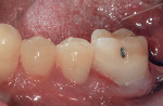 Final contoured and polished composites as viewed from the buccal.