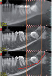 CT radiograph to assess the shape of the inferior alveolar nerve and root morphology.