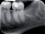 X-ray control. No residue is left in the root of the socket despite the abnormal morphology of root.