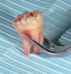 Extracted tooth showing complex crown and root morphology.