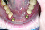 Fig 2. Occlusal view of implants on teeth Nos. 22 and 27.