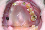 Fig 1. Occlusal view of implants on teeth Nos. 7 and 10.