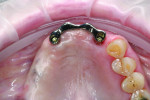 Fig 11. The mini bar for the teeth Nos. 7 through 10 area.