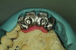 Fig 10. Wax denture teeth used to create a putty matrix.
