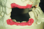 Fig 3. Soft tissue/model pour-up to examine the position of the teeth.