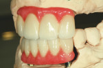Fig 19. The left-side and centric views show the color differentiation as well as occlusal contact support for the finished restorations.