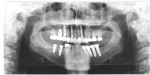 Fig 3. A preoperative panorex scan taken with the maxillary provisionals in place. Note the heavily restored dentition.