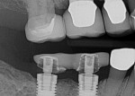 Fig 2. Radiograph of the provisional on implant Nos. 30 and 31.