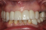 Fig 13. After treatment completion, the dentition in maximal intercuspal position.